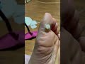 Take warts.