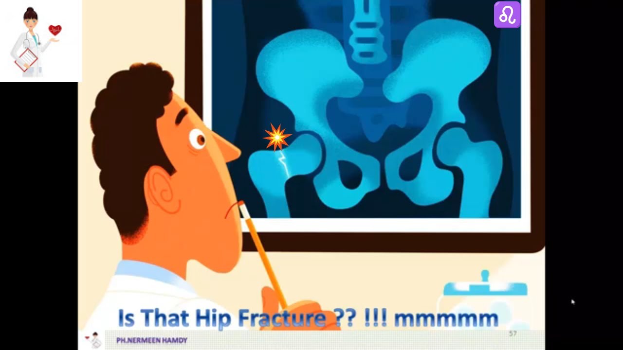 BoardOsteoporosis 6 CalcitoninSalmon ( Miacalcic) & Raloxifene