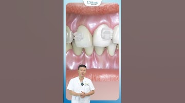 Niềng Răng Mắc Cài Sứ Thay Đổi Như Thế Nào ? | Bác Sĩ Yên