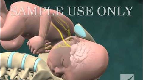 Birth Injury: Shoulder Dystocia with Brachial Plexus Stretching (Uterus Removed)