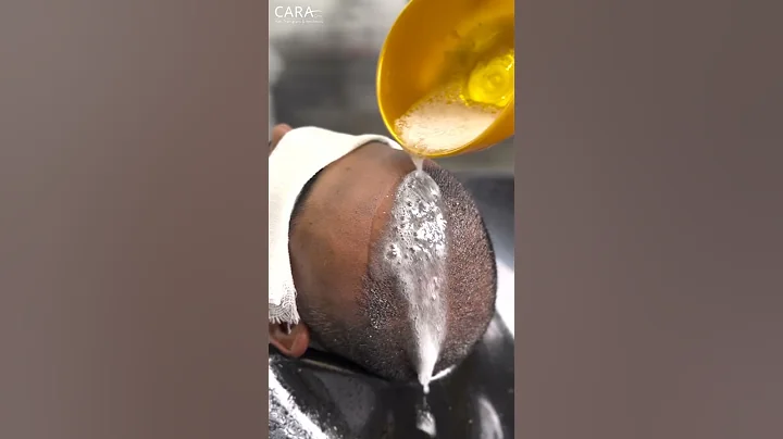 Expert Tips for First Shampoo After Hair Transplant | Cara Clinic