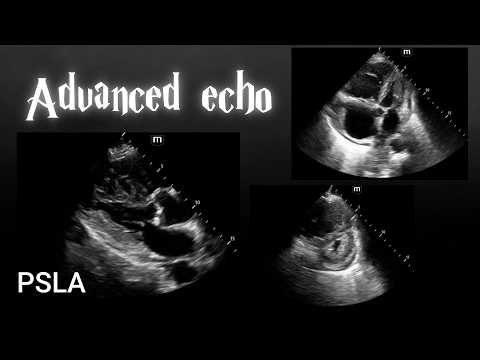 Seeing is Believing: How Ultrasound Transformed My Diagnosis of AKI [Case presentation]