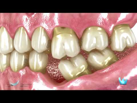 Vídeo: Extracción De Dientes: Causas, Métodos, Consecuencias