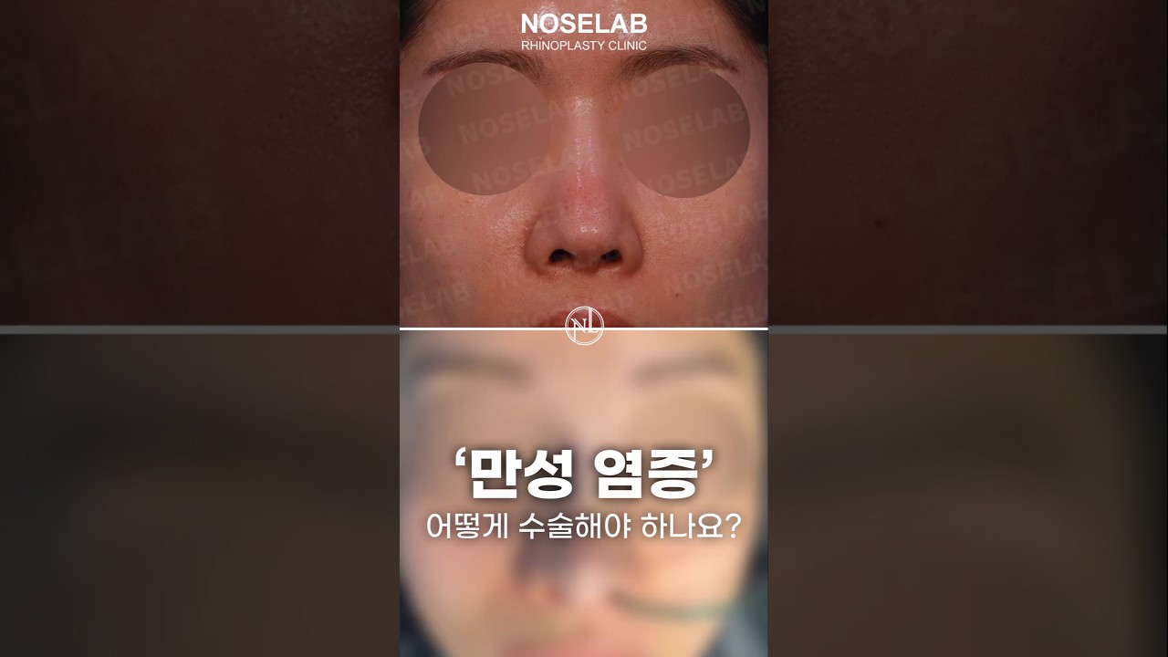 들린코 염증 재수술 자가늑연골 코재수술