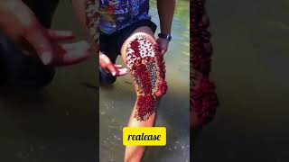 Why Do These Insects Stick?Ticks On Human Body.