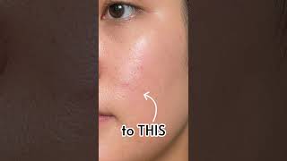 From breakouts to better skin ✨#Trubella #trendingreels #clinicallyproven