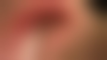 Physics Forceps Extraction of Upper Left Bicuspid from GoldenDent, Atraumatic Extraction