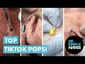 Dr pimple poppers top 10 tiktok pops