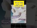 شاهد عملية جراحة لتقويم الفكين                                       تجميلاسنان  اكسبلور  ترند دندنها