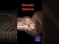 Baby Stuck During Birth | Shoulder Dystocia #shorts #pregnancy #youtubeshorts