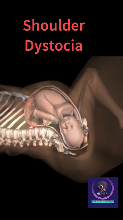 Baby Stuck During Birth | Shoulder Dystocia #shorts #pregnancy #youtubeshorts