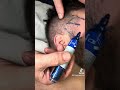 NEURALGIA ARNOLD, TRIGÉMINO, CEFALEAS