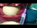 Intramuscular Injection Cefrtraxine 500 and dexamethasone push in the buttocks#iminjection#injection
