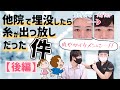 【抜糸後の再手術】もう一度二重になりたいを叶えました！Before＆After大公開！【男性二重整形】（後編）