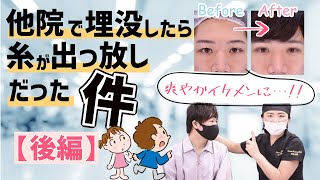 【抜糸後の再手術】もう一度二重になりたいを叶えました！Before＆After大公開！【男性二重整形】（後編）