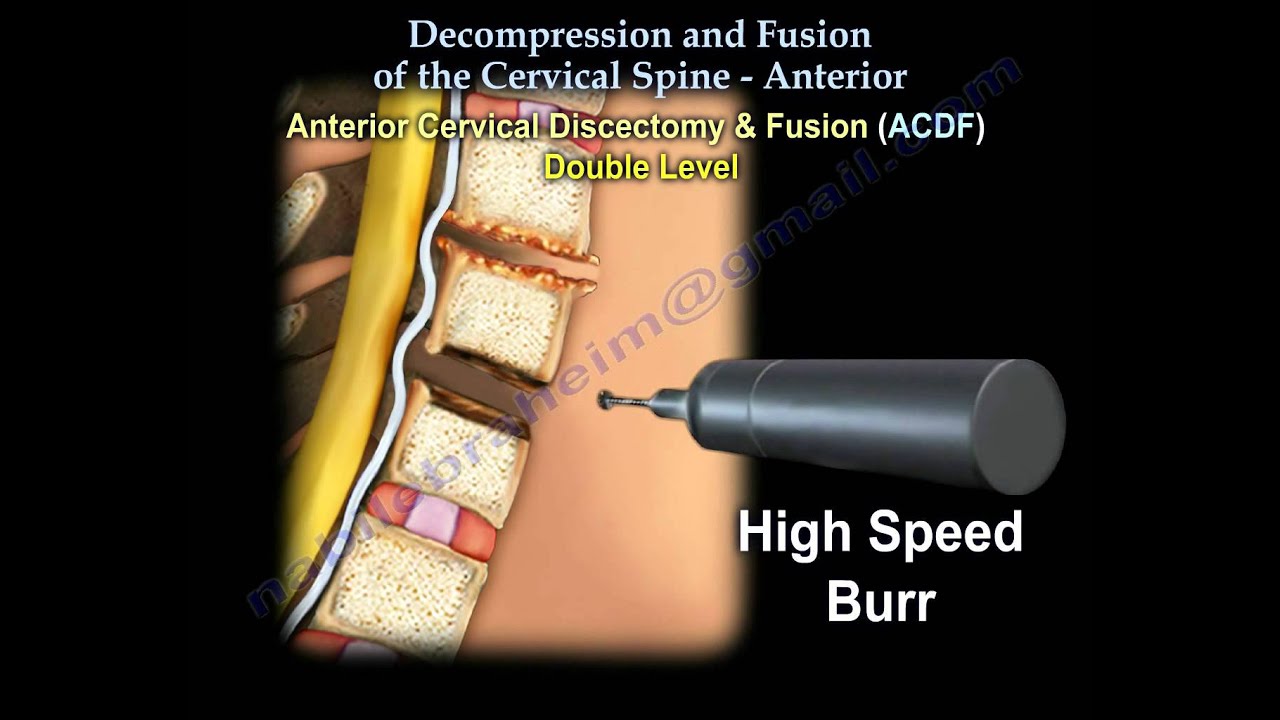 Cervical Spine ,Decompression And Fusion . - Everything You Need To