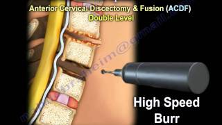 Cervical Spine ,Decompression And Fusion . - Everything You Need To Know - Dr. Nabil Ebraheim