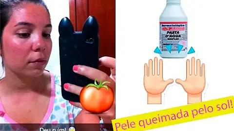 O que fazer quando pega sol demais?