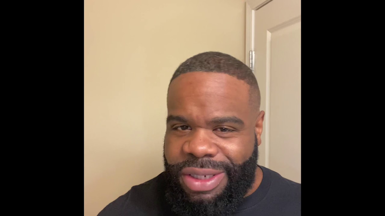6 months post 2nd hair transplant