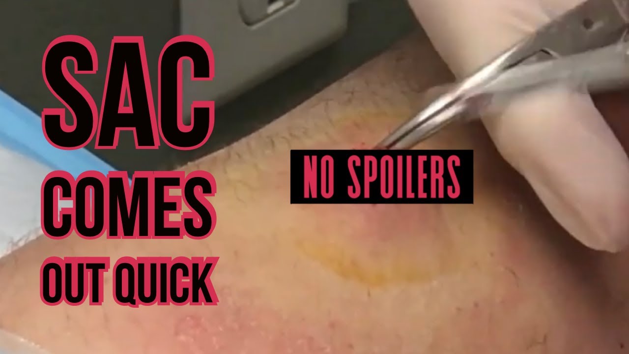 2019 Arm Cyst with Abby's Blackhead Mask YouTube