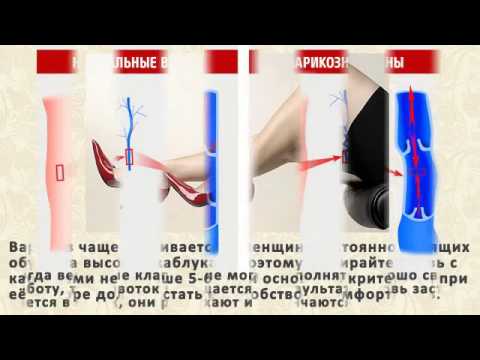 Яблочный уксус польза и вред при варикозе