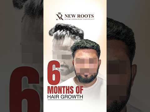 Receding Hairline (6 Months Results) | Hair Transplant in Nashik #hairtransplant #shorts