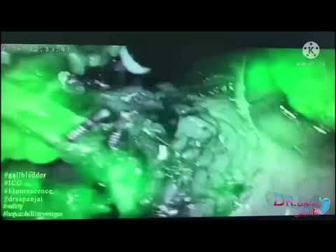 #safety #hepatobilliarysurgery #gallbladder #ICG #Fluorescence #drsapanjain