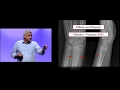 EEM 2019: Fracture Reduction Pro-Tips with Arun Sayal