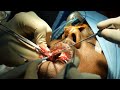 Hemangioma Removal - Surgical Method | Dr. Sunil Richardson