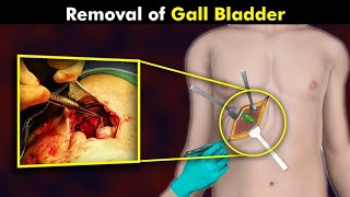 شاهد عملية إزالة المرارة _ Gallbladder removal surgery and laparoscopy