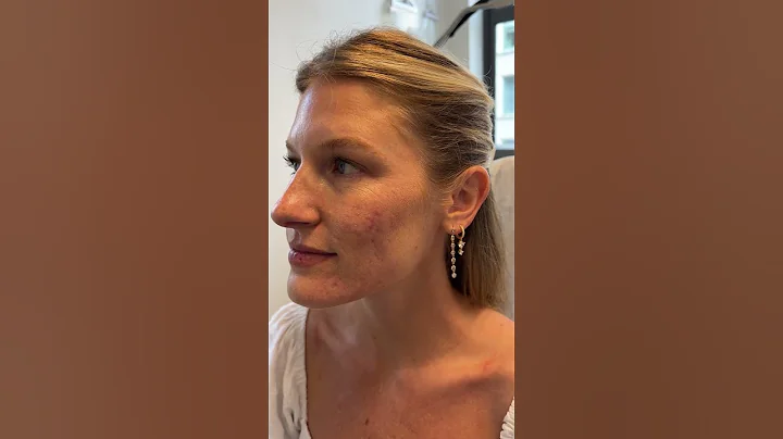 What laser treatments are best for acne scars?