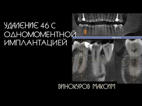 удаление 46 с одномоментной имплантацией