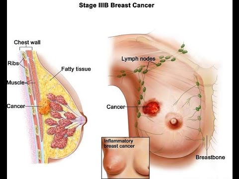 breast cancer is a malignant cancerous growth that begins in the