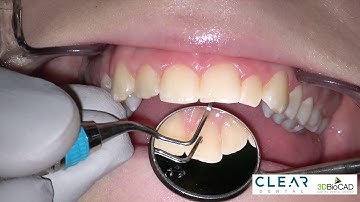 Mock-up Part 6 - Removal