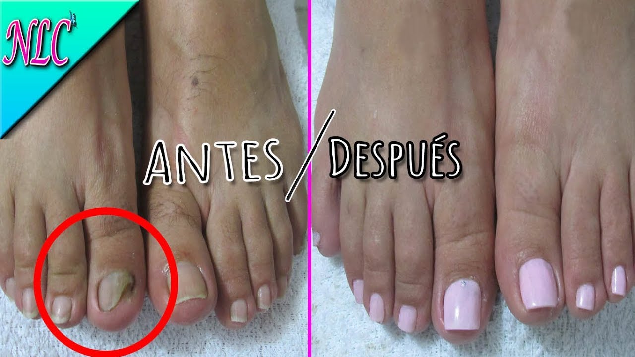 COMO ARREGLAR UÑA CON HONGO PASO A PASO - HOW TO PEDICURE - NLC - thptnganamst.edu.vn