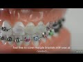 How to use dental wax on braces | Evolution Orthodontics