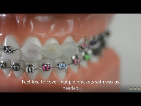 Video: Hoe om tandwas op braces aan te bring: 12 stappe (met foto's)