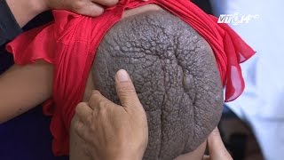 Vtc14Sóc Trăng Bé Gái Có Khối U Hình Mai Rùa Ở Lưng