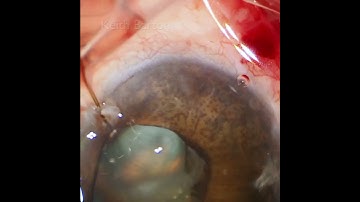 The "Cogan-Reese" variant of ICE syndrome at the start of a phaco in an eye with 2 glaucoma tubes