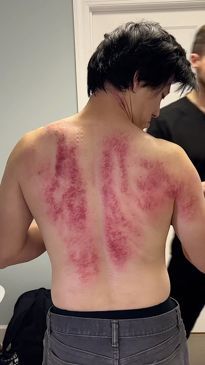Holy Smokes 😳 Cracks & Insane Gua Treatment! #shorts #chiropractor