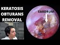 Low Grade Keratosis Obturans Removal With Mild Bleeding (Dense Collection of Skin In Ear Canal)