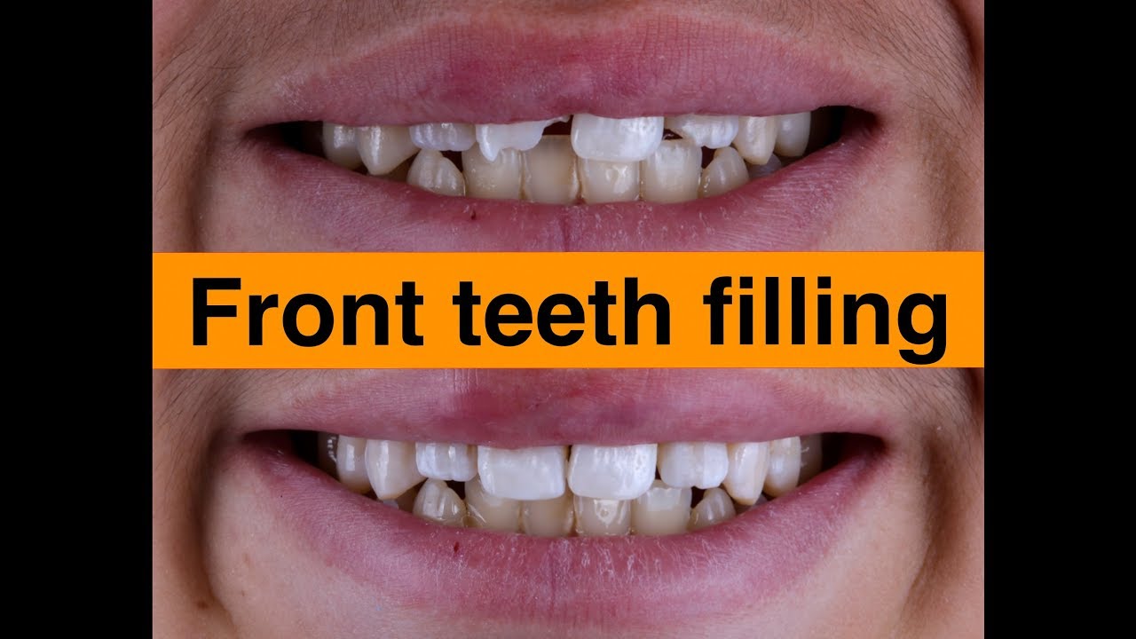 Front teeth filling YouTube