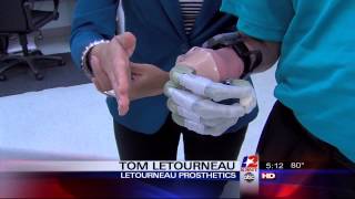 61-year-old Beaumont man receives bionic fingers