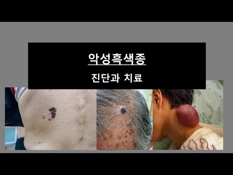 악성흑색종 : 진단과 치료