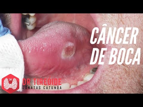 Câncer de boca - Sintomas, Diagnóstico, Tratamento e Prognóstico | Dr Jônatas Catunda