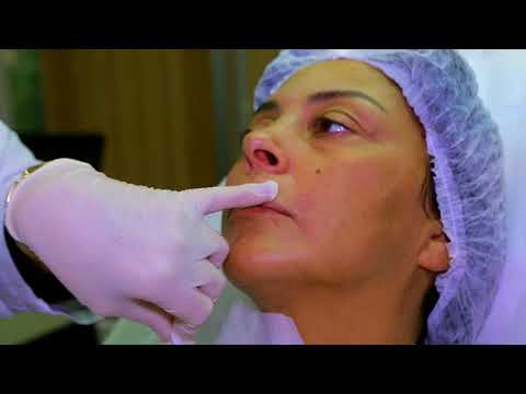 ცხვირ-ტუჩის ნაოჭის გასწორება ესთეტიკურ კლინიკა ნეო-ნეოში