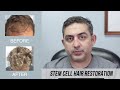 Stem Cell Hair Restoration (Success Story)