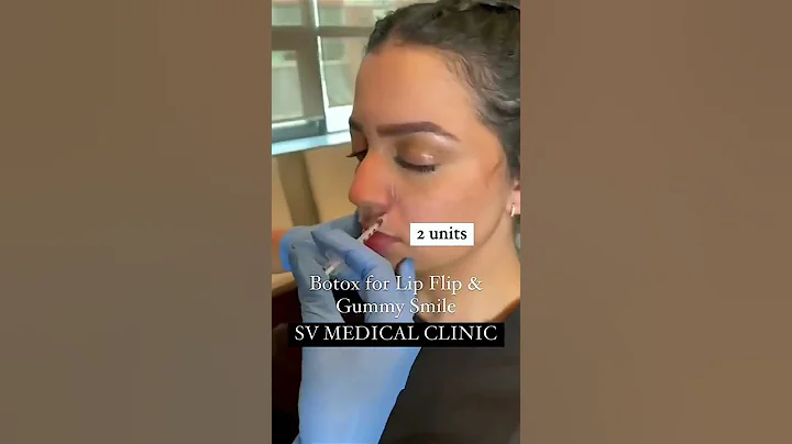 BOTOX Results: Quick, Easy Solution for Gummy Smile and Lip Flip | Skin Vitality Medical Clinic