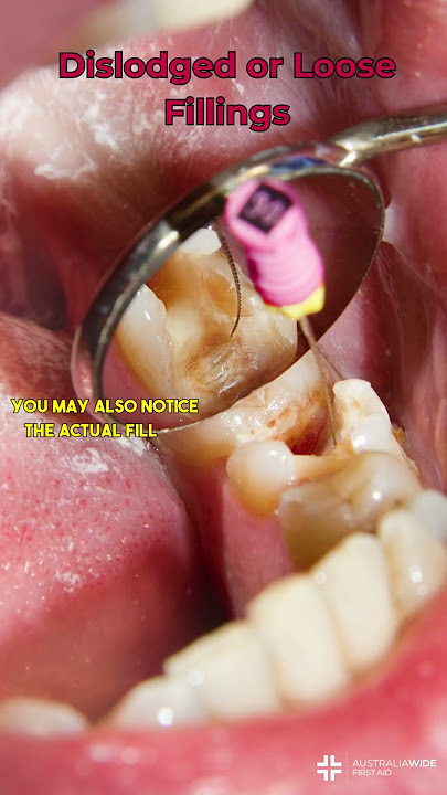 Dislodged or Loose Fillings #dentist #filling
