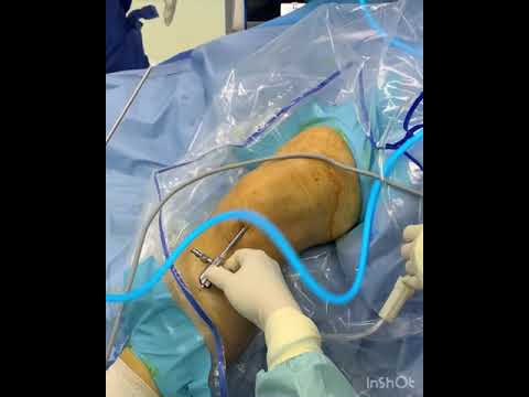 VIDEO PROSEDUR #CHEFZAM MENJALANI PEMBEDAHAN LUTUT “arthroscopic debridement surgery” @KPJ Tawakal